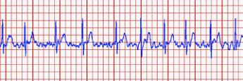 ECG/EKG diagnosis of AFib